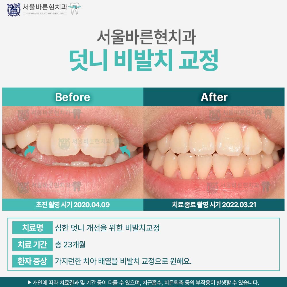 부산치아교정