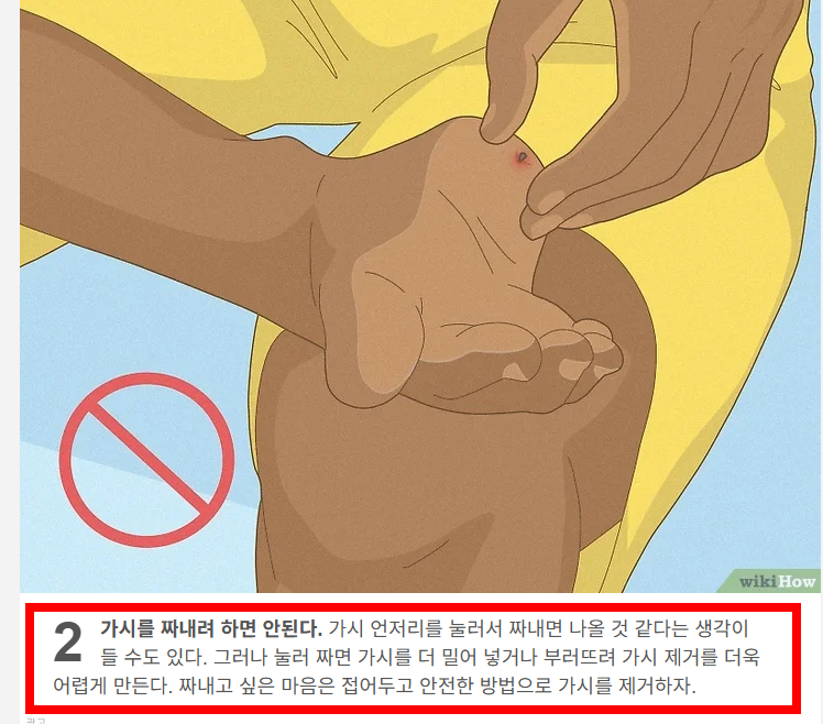 손가락 가시 빼는법 소개