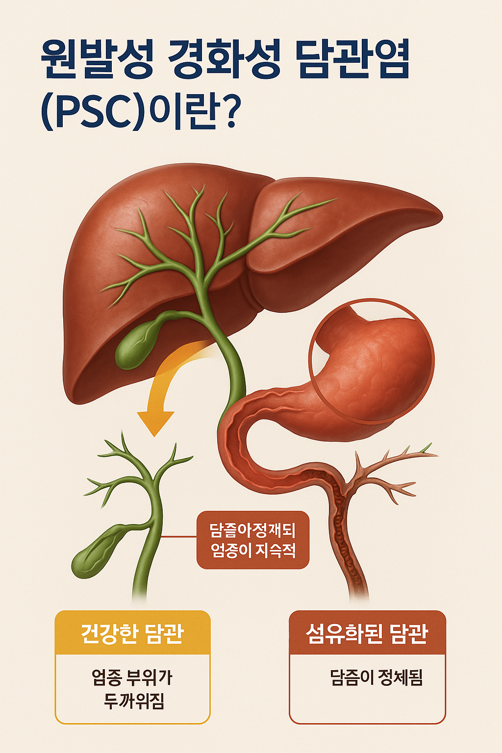 1.원발성 경화성 담관염(PSC)