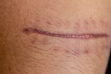 귓볼 몽우리 원인들, 뒤 피지낭종을 아시나요? 귓볼 몽우리는 귀걸이를 오래 착용한 경우 흔히 발생하기 때문에 질환이 있음에도 불구하고 방치하는 분들이 많습니다. 하지만 귓볼에 생긴 혹이 지방종이나 피지낭종과 같은 양성종양일 경우 크기가 커질 수 있다는 점을 고려하여 빠른 시일 내에 제거하는 것이 중요합니다.