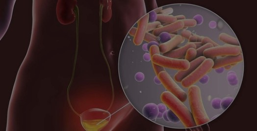 방광염 증상과 원인, 자연치료, 좋은음식