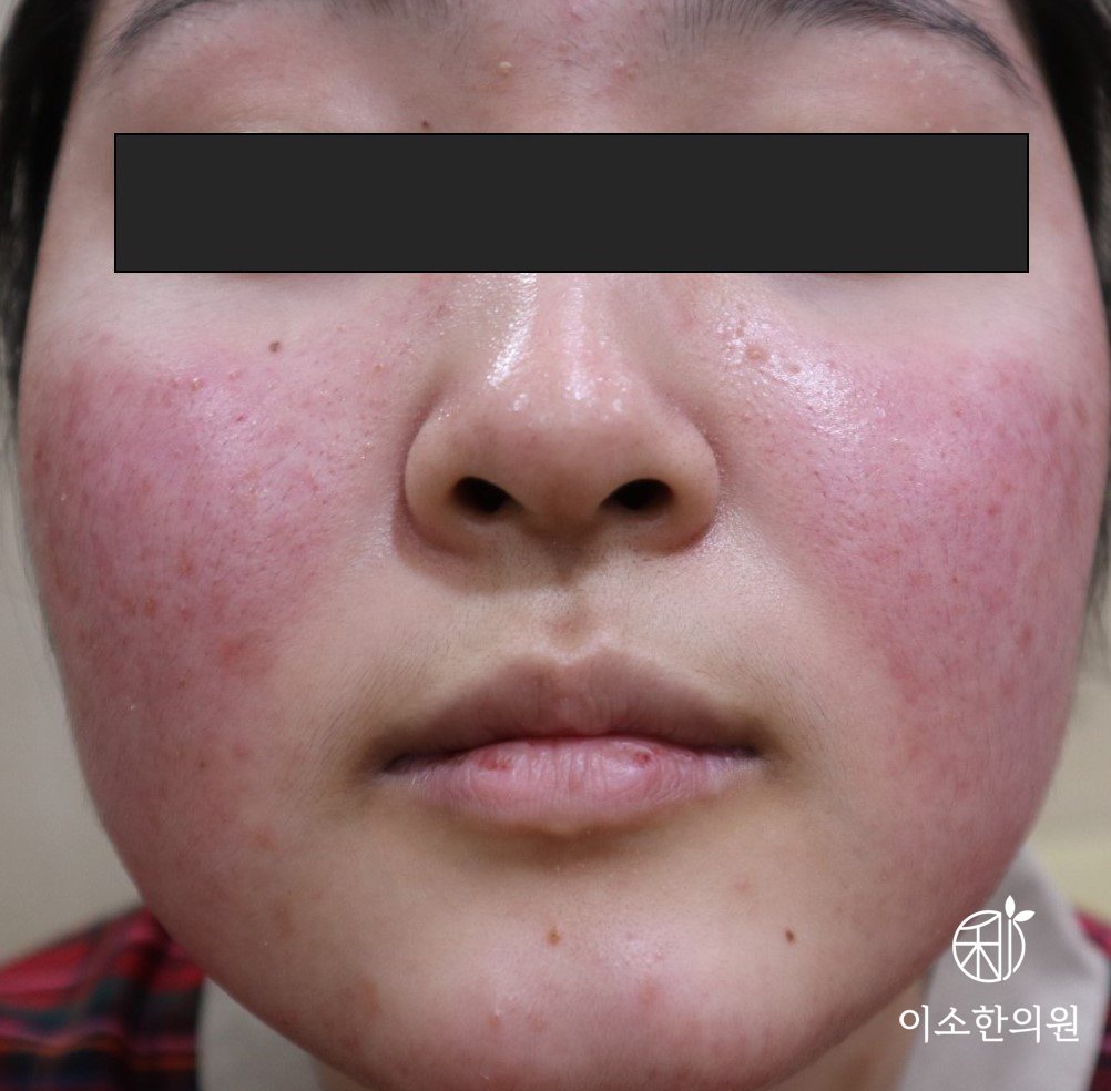 주사피부염