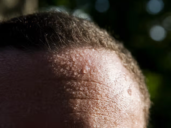 머리에서 땀이 많이 나는 이유