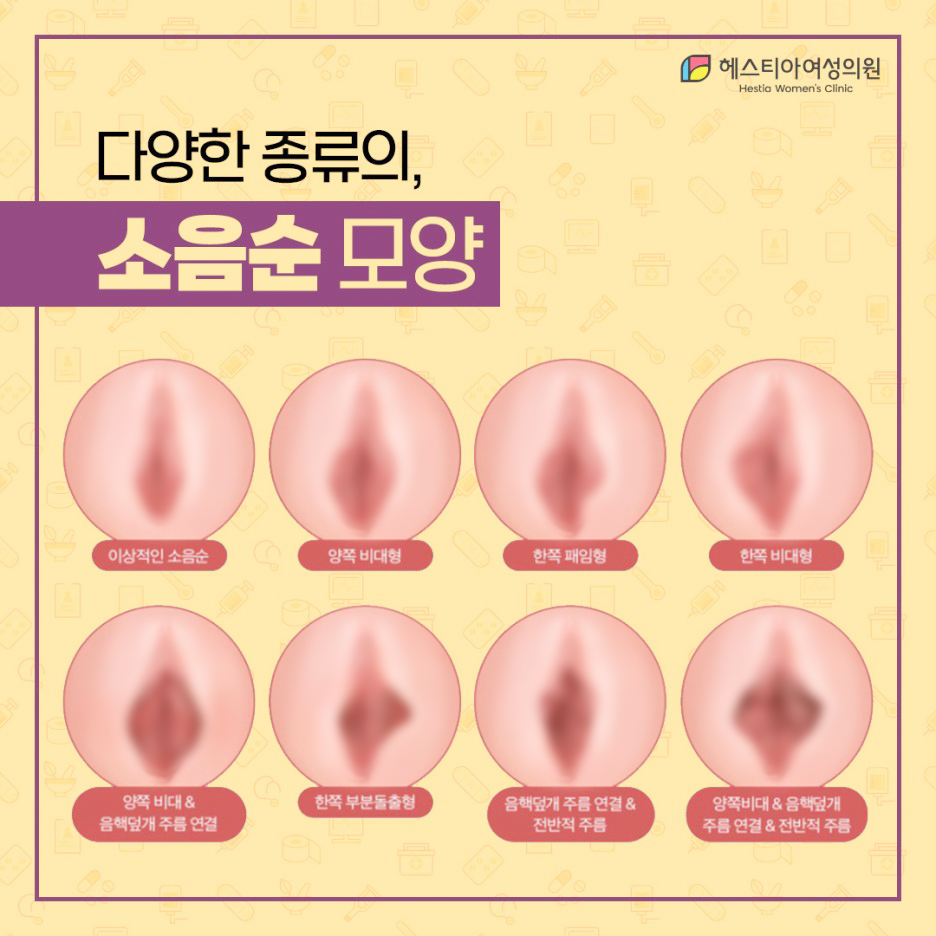 다양한 종류의 소음순모양