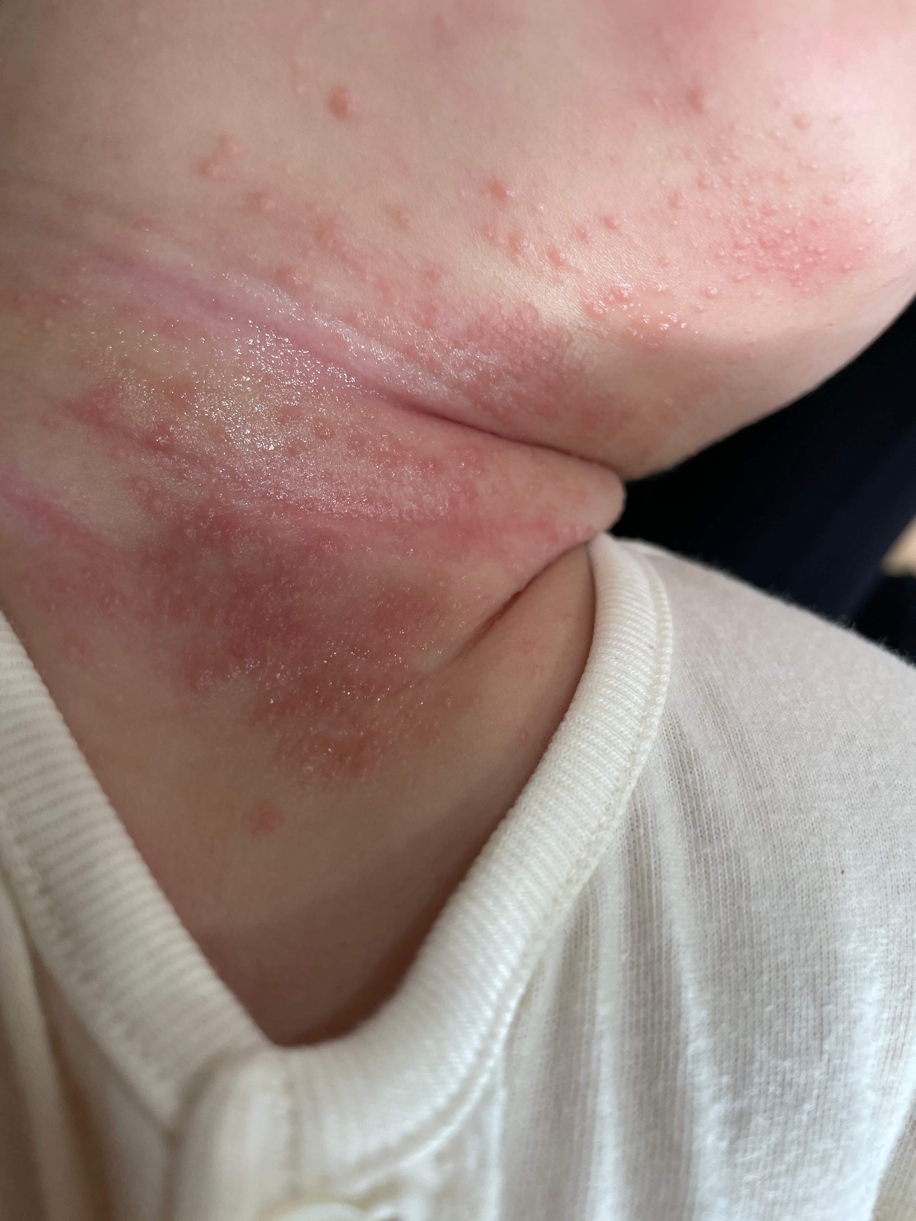 영유아 아토피 치료후기(ft.제로이드) - 생후 5개월 아토피