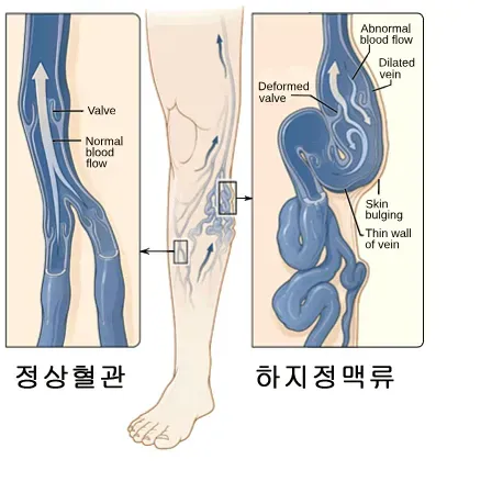 하지 정맥류 증상 치료방법과 예방 생활습관_3