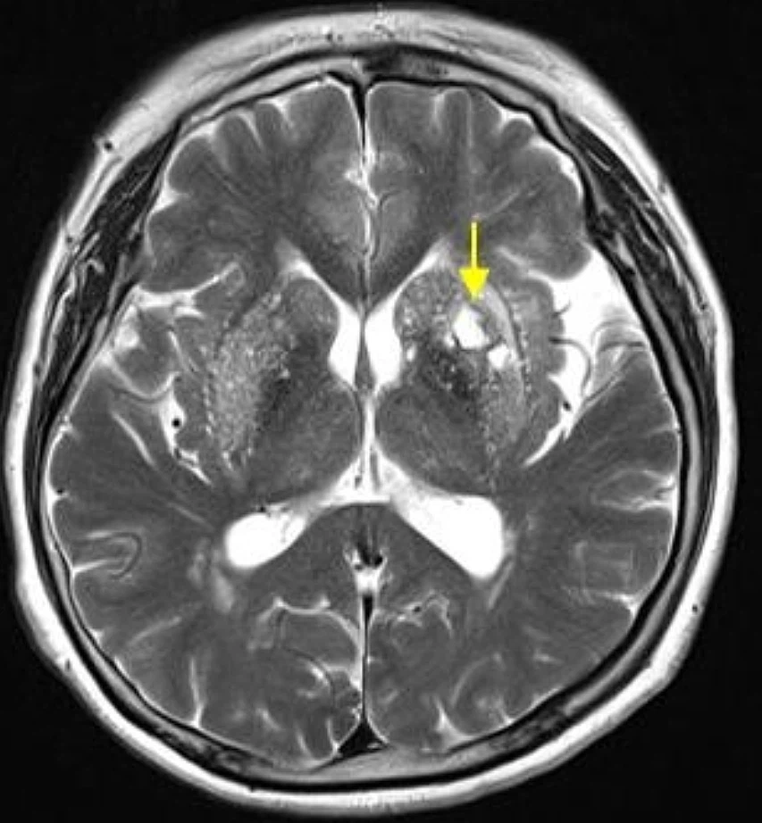 뇌졸중 전조증상