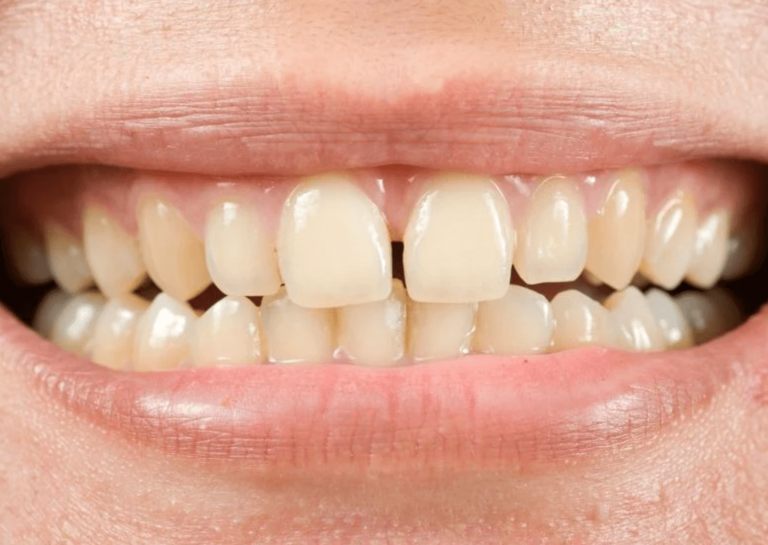 벌어진 앞니 레진