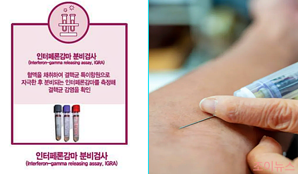 인터페론-감마 분비검사란?