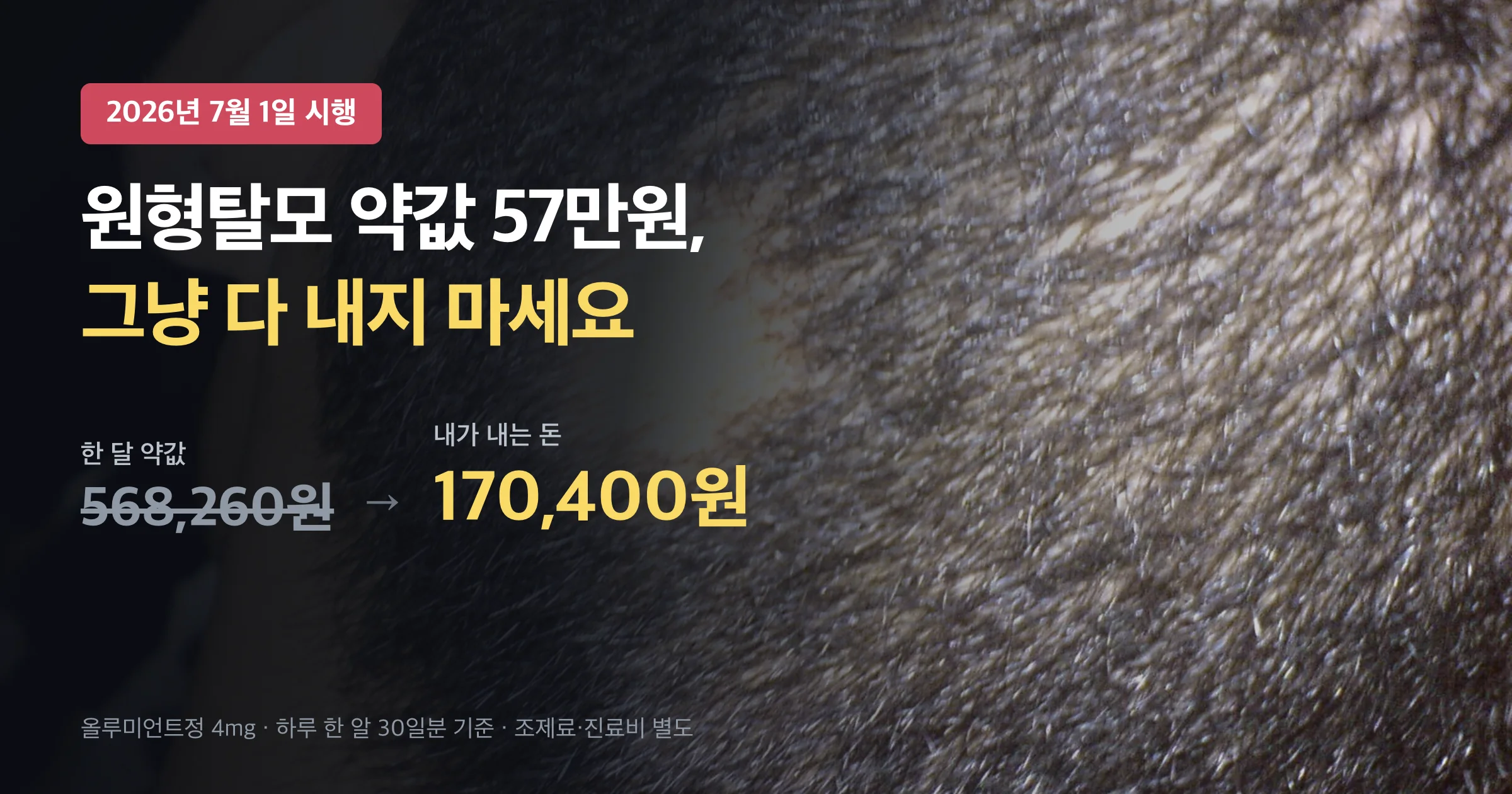 원형탈모 약값이 2026년 7월부터 한 달 568,260원에서 170,400원으로 낮아졌다는 요약 이미지