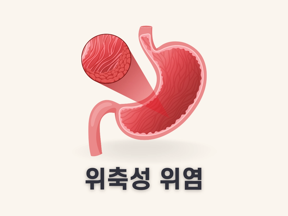 위축성 위염