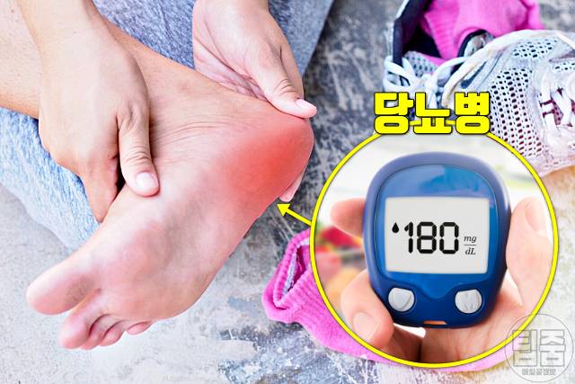 발뒤꿈치 찌릿 따끔 발바닥 전기 통증 당뇨병