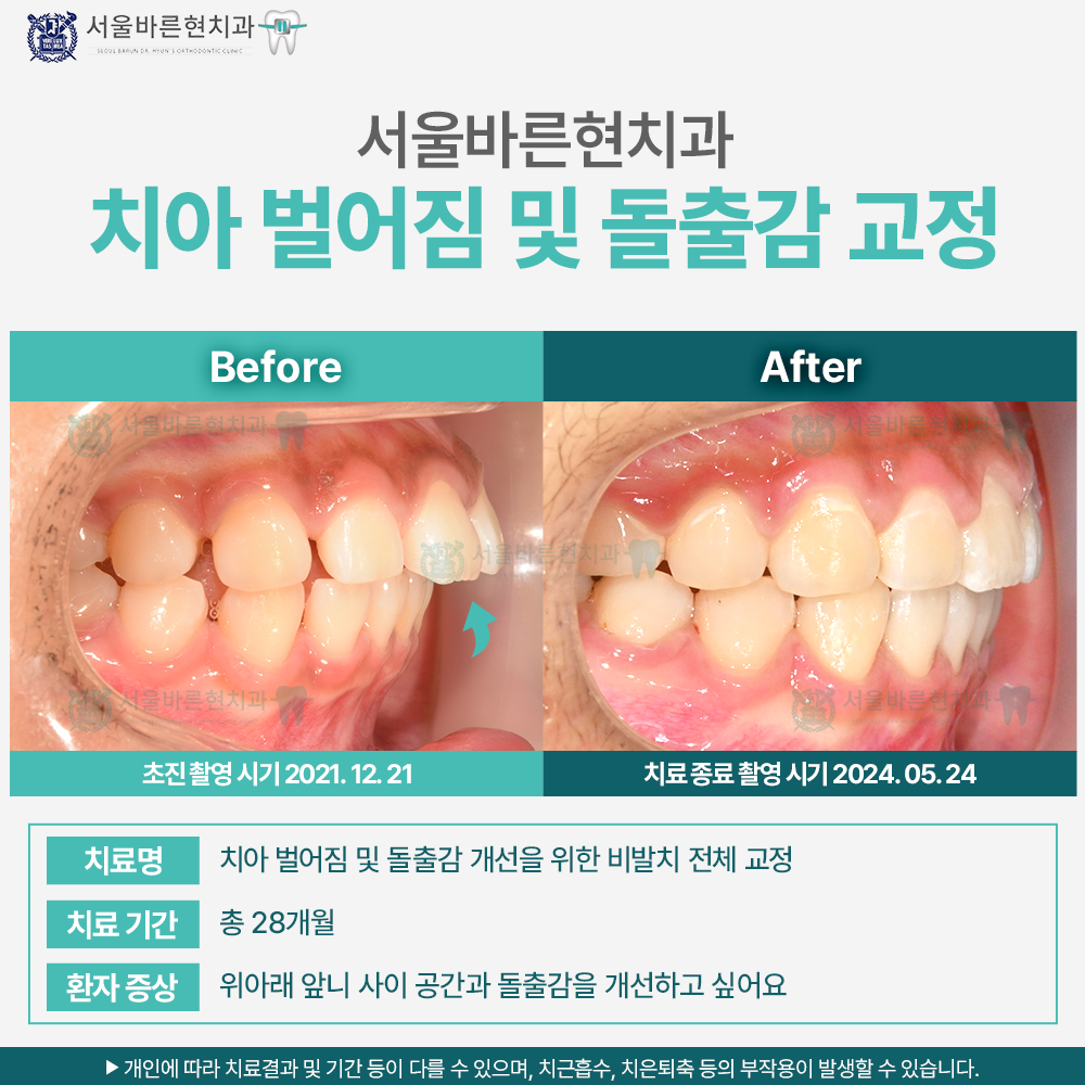 해운대비발치교정