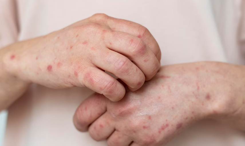 아토피 피부염 잘 알고 적절한 치료해요