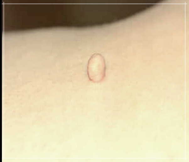 사타구니 쥐젖 치료비용에 대해 알아보기