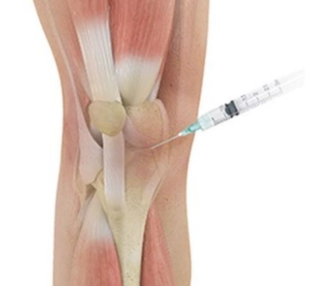 관절염 주사 이미지