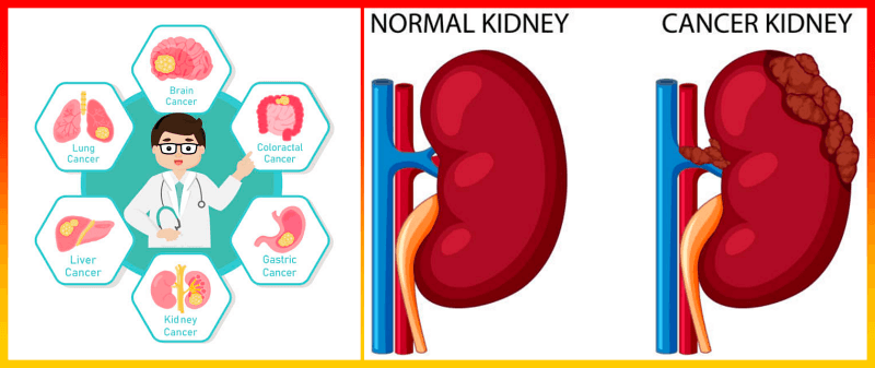 신장 콩팥암 위치