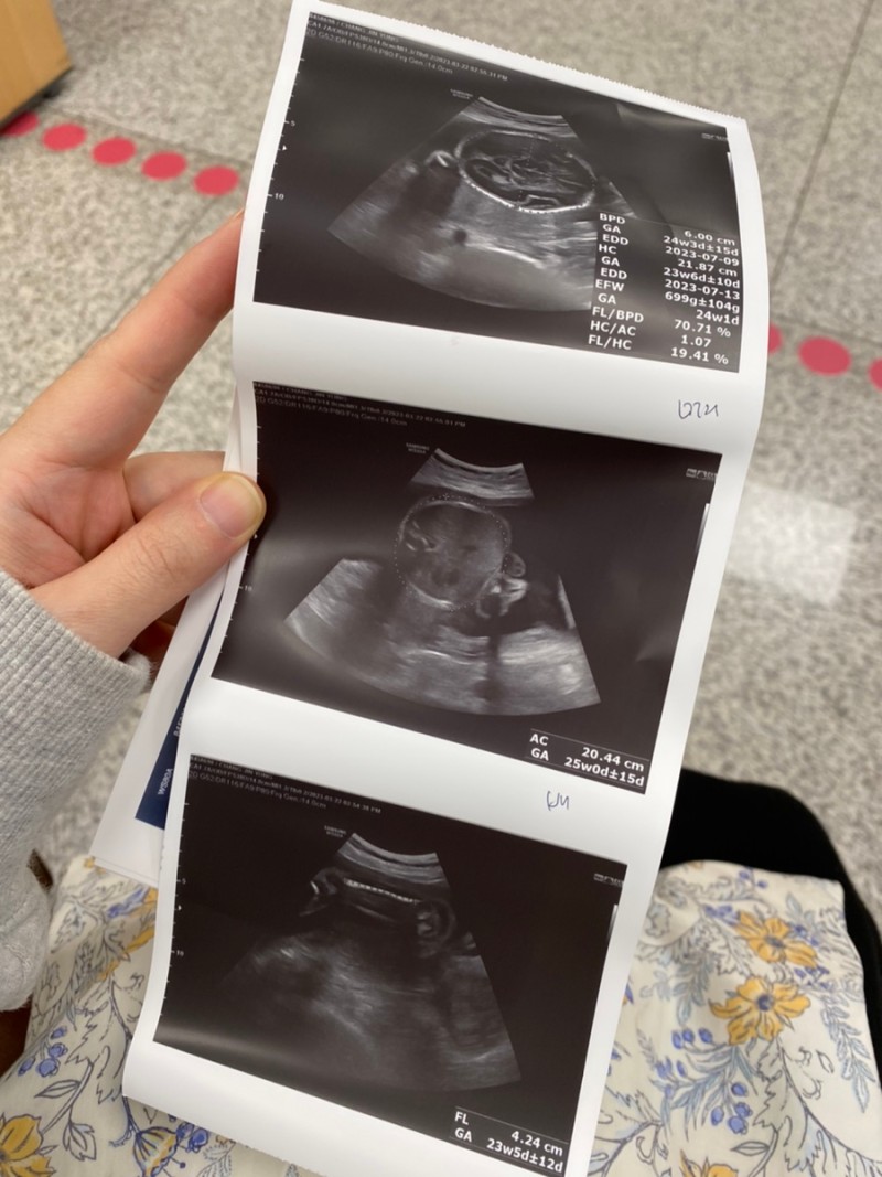 세브란스입체초음파