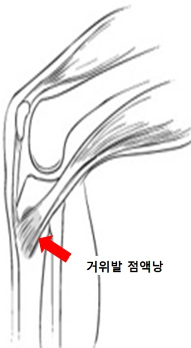 거위발 점액낭염이란? 원인과 치료 방법