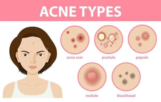 화농성 여드름 연고 3가지 추천