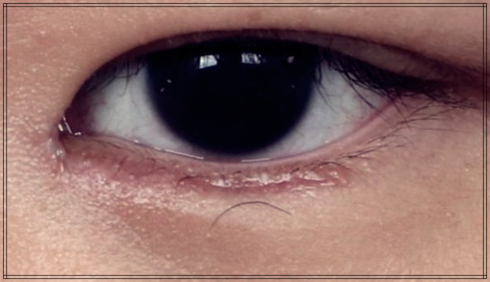 안검 내반 수술: 장점과 단점