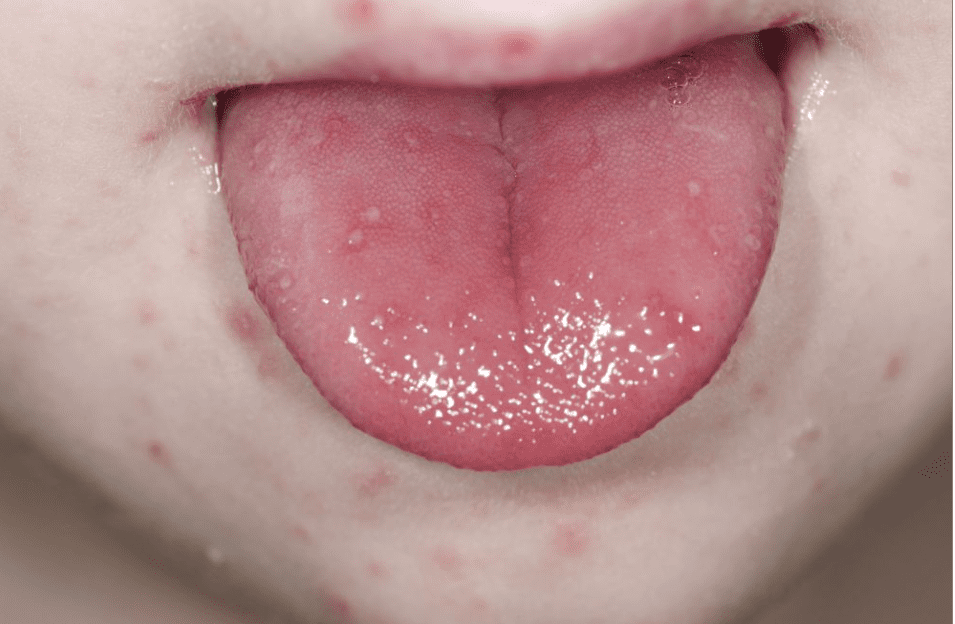 수족구 증상 중 입 속 발진이 난 상태
