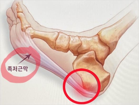 족저근막염