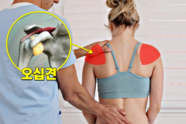 등 위쪽 통증 5, 등이 아픈 증세, 오십견 증상, 생로병사의 비밀