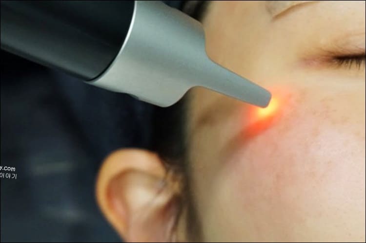 비립종 레이저 치료