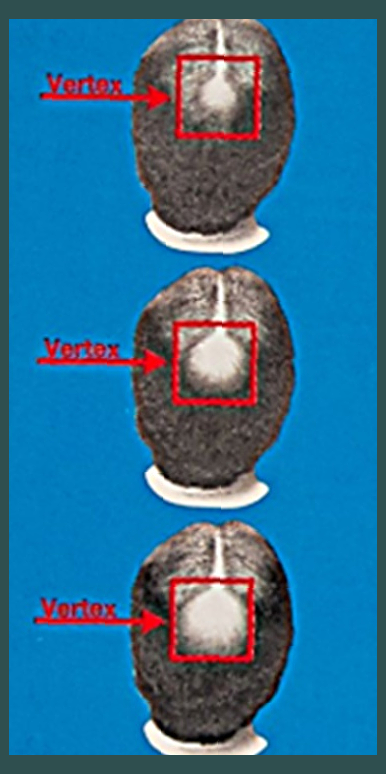 커클랜드 미녹시딜 직구