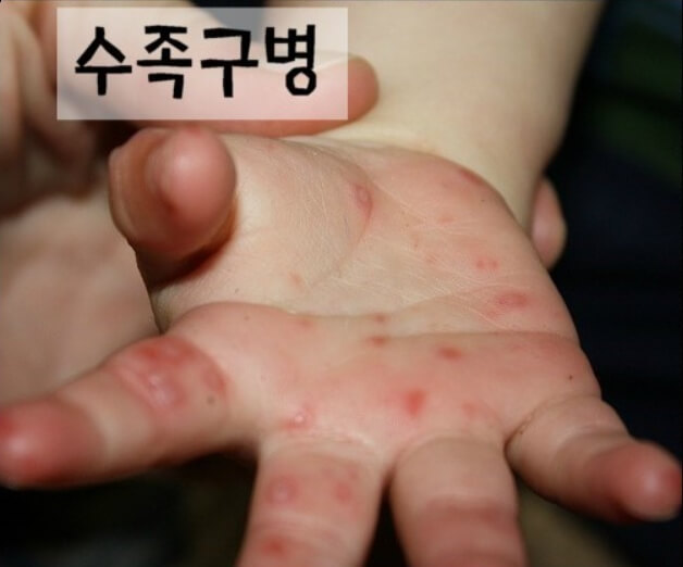 수족구병
