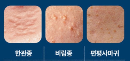 한관종 비립종 편평사마귀 차이