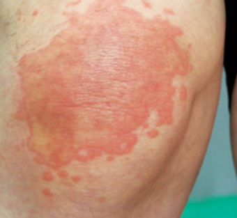 두드러기 원인 1