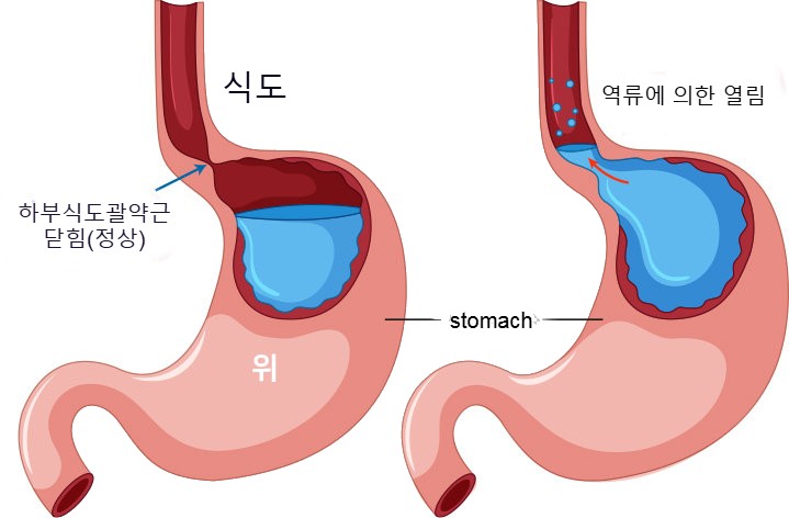 역류성 식도염의 증상