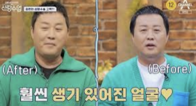 눈밑지방재배치 잘하는 곳