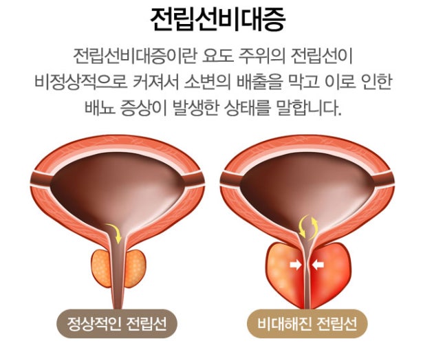 전립선 비대증의 증상 및 원인, 치료방법