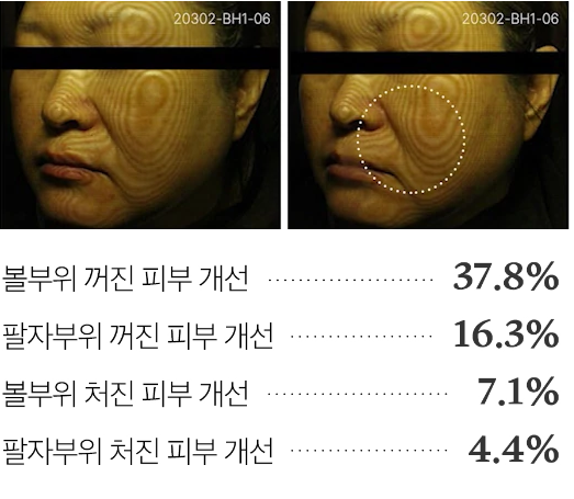 4주 사용으로 인한 피부 탄력 변화
