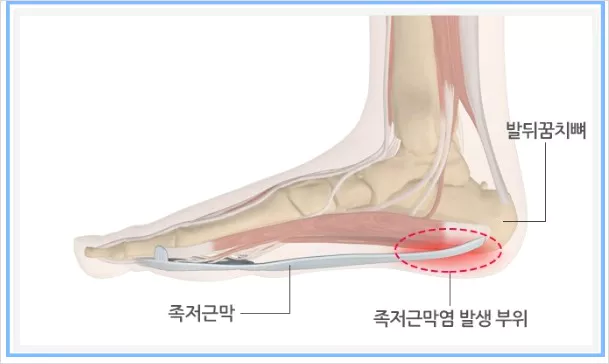 족저근막염 발생 부위