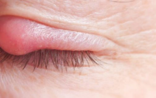 다래끼 빨리 낫는법