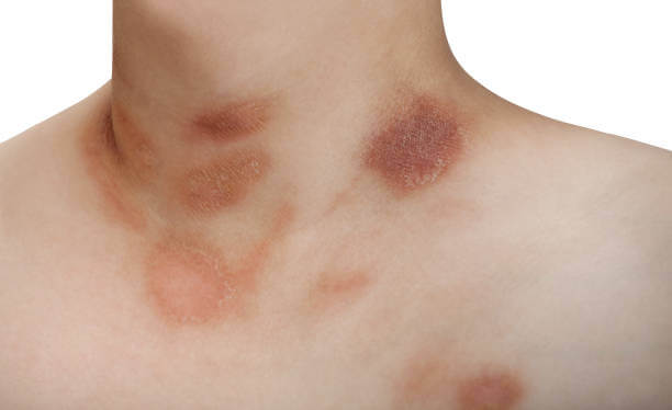 장미색 비강진 원인, 치료, 재발 등에 대해 알아봤습니다. 장미색 비강진은 pityriasis rosea이라고 불리는데요. 어떤 증상과 원인 치료가 있는지 꼼꼼히 읽어보세요!