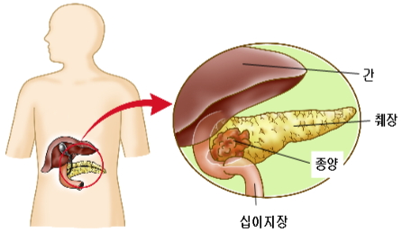 췌장암 초기 증상