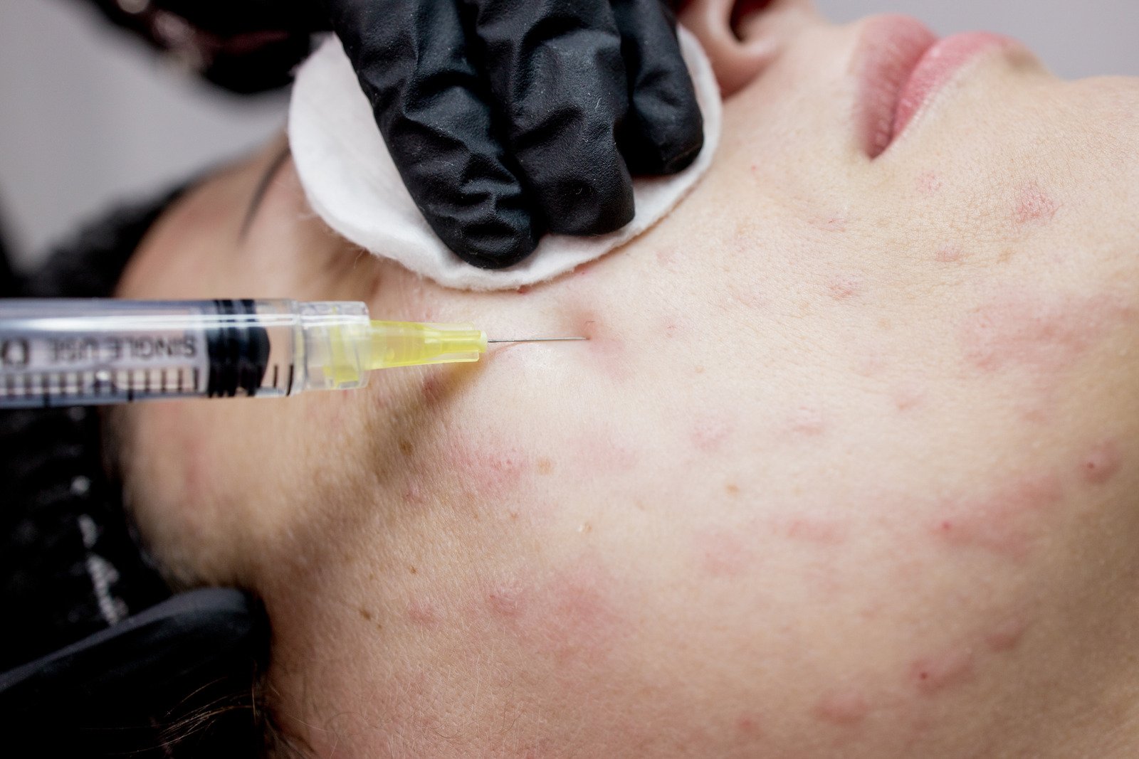 기미·잡티 치료, '지우개 주사'로 해결! – 색소 침착을 지우는 시술법