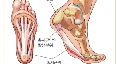 족저근막염 이미지