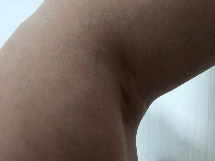 무릎-안쪽에-발생한-물혹