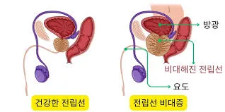 전립선비대증 치료