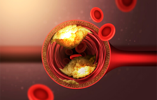 고지혈증에 좋은 음식