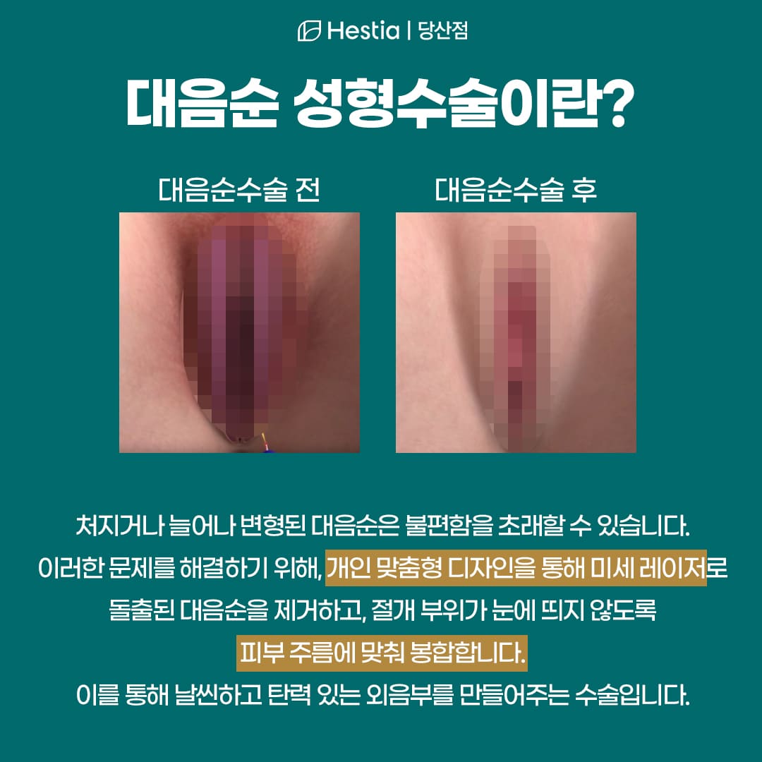 대음순성형수술이란?