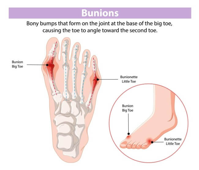 무지외반증 증상