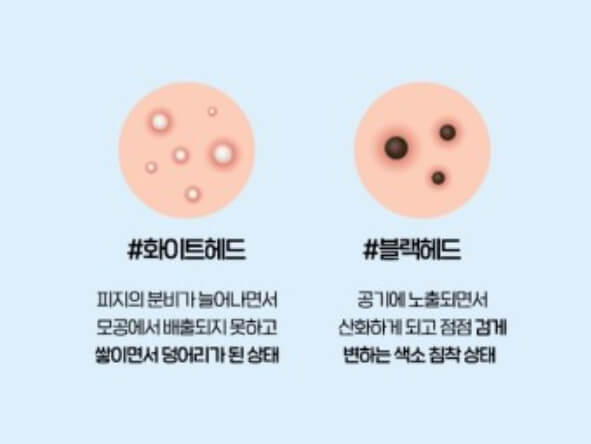 블랙헤드와 화이트헤드