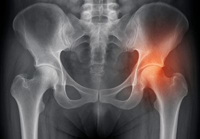 고관절통증 증상과 원인